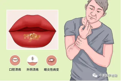白塞病